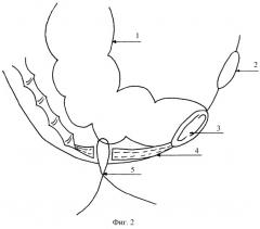 Способ низведения сигмовидной кишки при брюшно-анальной резекции прямой кишки (патент 2284760)