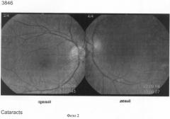 Способ диагностики начальной оптически значимой катаракты (патент 2310370)