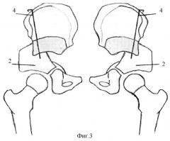 Способ хирургического лечения двухсторонней дисплазии тазобедренного сустава (патент 2269960)