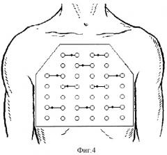 Способ лечения множественных двойных переломов ребер и устройство для его осуществления (патент 2300331)