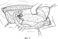 Способ хирургического лечения рецидивных паховых грыж (патент 2376940)