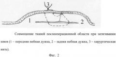 Способ хирургической профилактики кровотечения при тонзиллэктомии (патент 2546094)