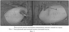 Способ устранения синдрома врастания торца культи плеча в мягкие ткани (патент 2394515)