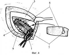 Способ безнатяжной комбинированной пластики пахового канала по петрову-кошеву (патент 2303403)