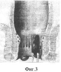 Способ малоинвазивного лечения геморроя (патент 2427331)