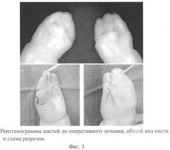 Способ оперативного лечения клинодактилии первого пальца кисти при акроцефалосиндактилии (патент 2546503)