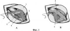 Способ протезирующей пластики при паховых грыжах (патент 2547080)