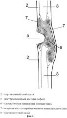 Способ лечения хронического остеомиелита длинных костей конечностей (патент 2544303)