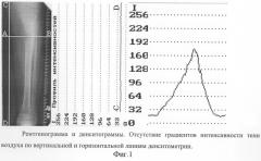 Способ фотоденситометрии рентгенограмм или их оцифрованных изображений (патент 2281030)