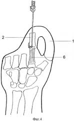 Способ реконструкции кисти при ампутационных культях всех пальцев (патент 2572551)