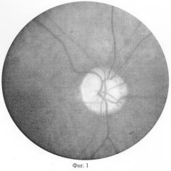 Способ прогнозирования эффективности лечения при частичной атрофии зрительного нерва (патент 2282391)