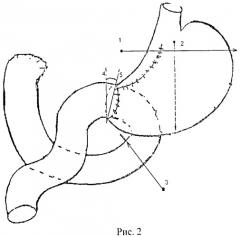 Способ формирования гастроэнтероанастомоза (патент 2533029)