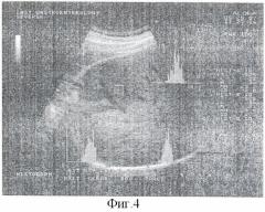 Способ оценки эхогенности паренхимы печени (патент 2381750)