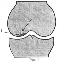 Способ выполнения субхондральной спицевой туннелизации бедренной кости при хондромаляции суставного хряща (патент 2454195)