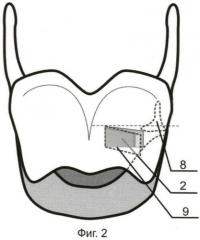 Способ медиафиксации голосовой складки в лечении больных с односторонними параличами гортани (патент 2458644)