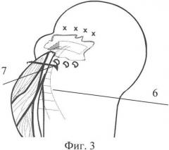 Способ хирургического лечения массивных застарелых разрывов сухожилий ротаторной манжеты плеча (патент 2429793)