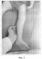 Способ лечения сгибательной контрактуры коленного сустава и косолапости у детей (патент 2453286)