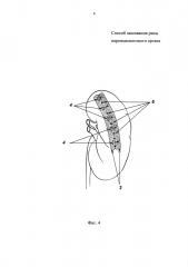 Способ зашивания раны паренхиматозного органа (патент 2606181)