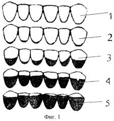 Способ определения отложений зубного налета у пациентов с мостовидными протезами (патент 2286719)