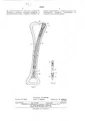 Устройство для соединения отломков трубчатых костей (патент 439955)