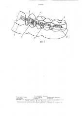 Ортодонтический аппарат для дистального перемещения зубов (патент 1502023)