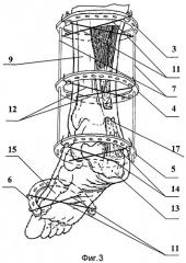 Способ лечения свежих разрывов ахиллова сухожилия (патент 2381761)