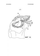 Восстановление крепления рога мениска (патент 2626131)