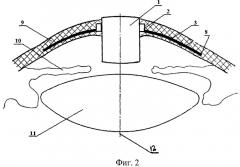 Кератопротез (патент 2481083)