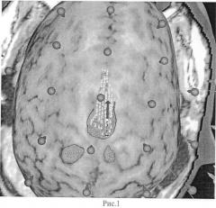 Способ выявления в коре головного мозга сенсомоторных зон, ответственных за локомоцию (патент 2504329)