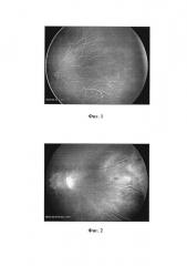 Способ прогнозирования развития поздних ретинальных осложнений у пациентов с различными стадиями рубцовой ретинопатии недоношенных на основании данных флюоресцентной ангиографии (патент 2665956)