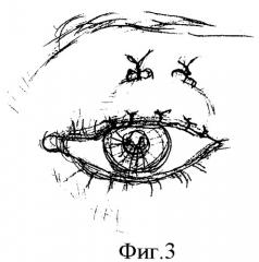 Способ устранения сквозного краевого дефекта верхнего века (патент 2380066)