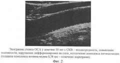 Способ диагностики системной красной волчанки и антифосфолипидного синдрома у детей (патент 2435524)