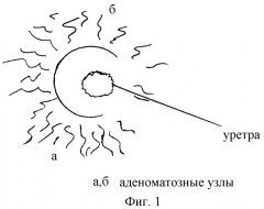 Устройство для отделения аденоматозных узлов от уретры (патент 2266066)