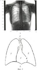 Способ определения контура сердца на флюорографических снимках (патент 2478337)