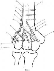 Способ лечения переломов мыщелков плеча (патент 2466693)