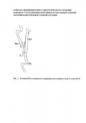 Способ одномоментного хирургического лечения больных с патологической извитостью общей сонной артерии и внутренней сонной артерии (патент 2618209)