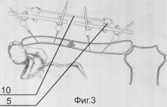 Способ и устройство для лечения диафизарных переломов и ложных суставов ключицы (патент 2297805)