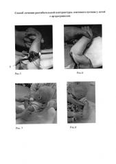 Способ лечения разгибательной контрактуры локтевого сустава у детей с артрогрипозом (патент 2585744)