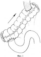 Способ толстокишечной гастропластики после гастрэктомии (патент 2278619)