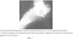 Способ устранения посттравматического плоскостопия (патент 2413474)