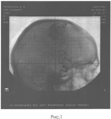 Способ лечения артериовенозных мальформаций головного мозга (патент 2534233)