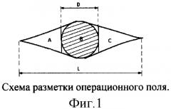 Способ сочетанного закрытия дефекта кожи местными тканями и свободными кожными лоскутами (патент 2326609)