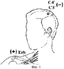 Способ диагностики формирования посттравматического вегетативного статуса у больных с тяжелой черепно-мозговой травмой (патент 2342069)
