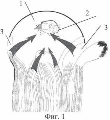 Способ хирургического лечения массивных застарелых разрывов сухожилий ротаторной манжеты плеча (патент 2429793)