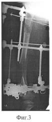 Способ удлинения трубчатой кости (патент 2258482)