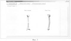 Способ трехмерной визуализации длинных трубчатых костей при диафизарных переломах (патент 2342077)