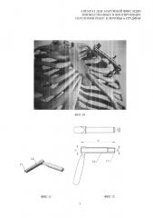 Аппарат для наружной фиксации множественных и флотирующих переломов ребер, ключицы и грудины (патент 2637834)
