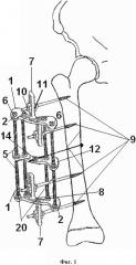 Аппарат для лечения оскольчатых переломов бедренной кости у детей (патент 2629050)