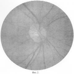 Способ диагностики атрофии зрительного нерва (патент 2282390)
