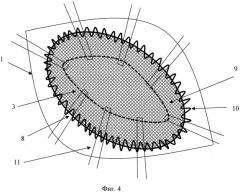 Способ пластики передней брюшной стенки при боковых и переднебоковых грыжах (патент 2571008)
